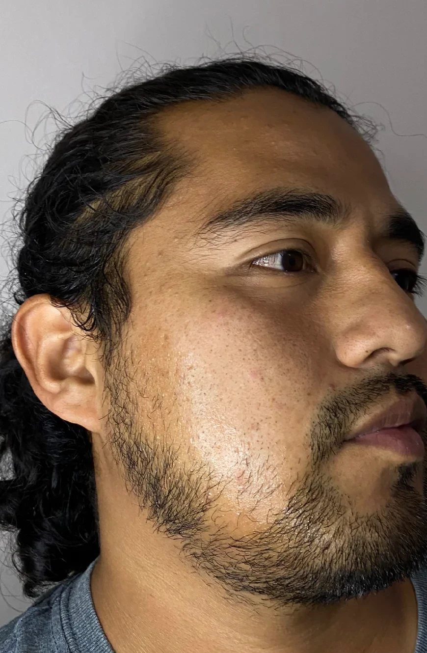 Barba rala antes de usar el balsamo